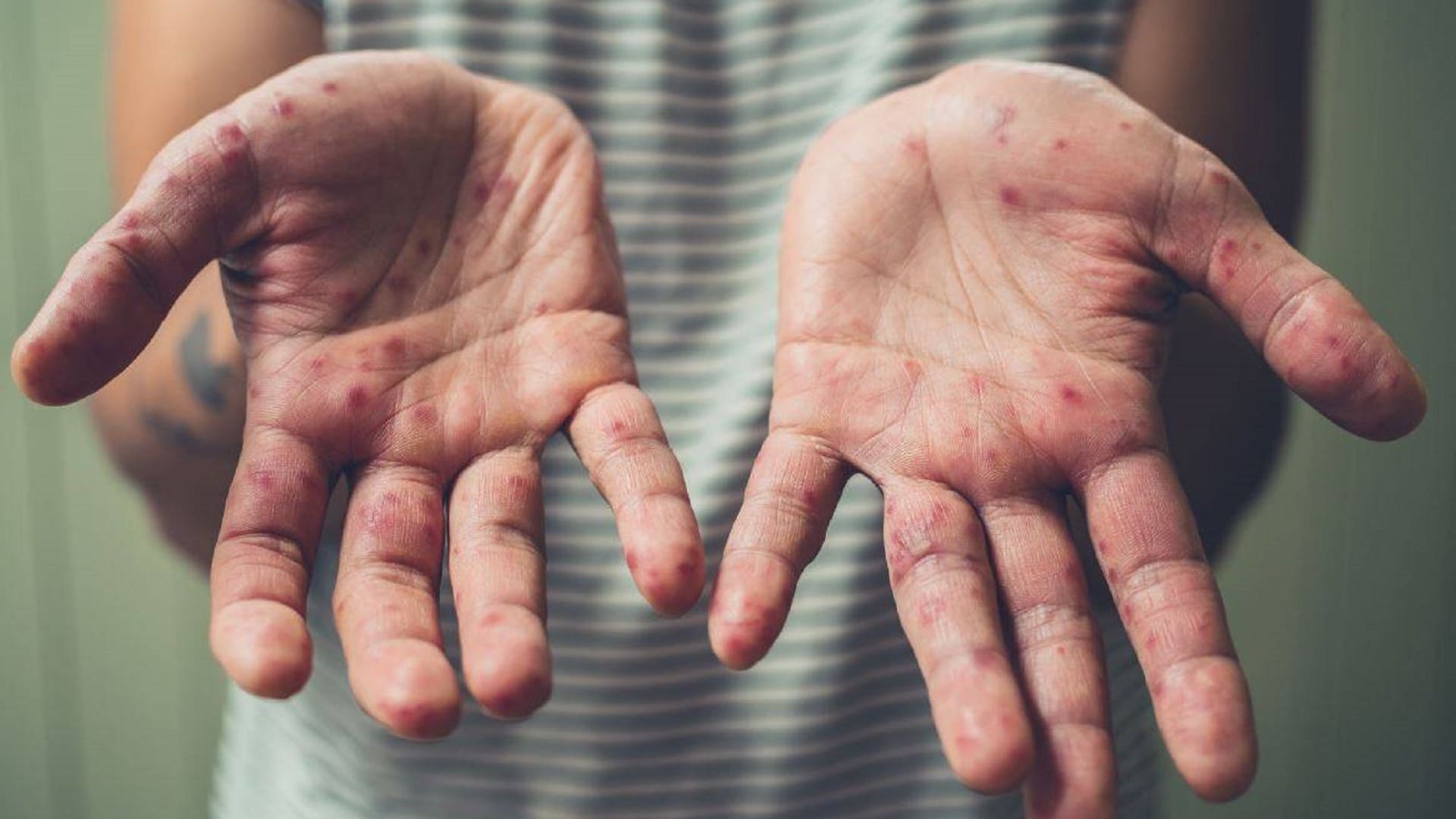 Emite Oaxaca alerta sanitaria por aumento de casos de sarampión y tosferina