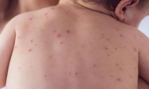 Oaxaca activa cerco sanitario por brote de sarampión en tres comunidades