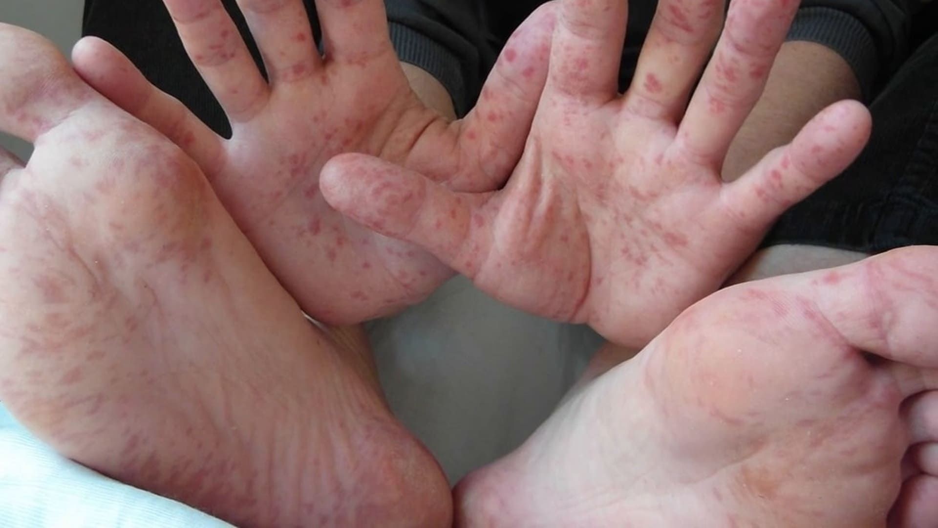 En Oaxaca, dos casos de virus coxsackie; UNAM urge a tomar medidas