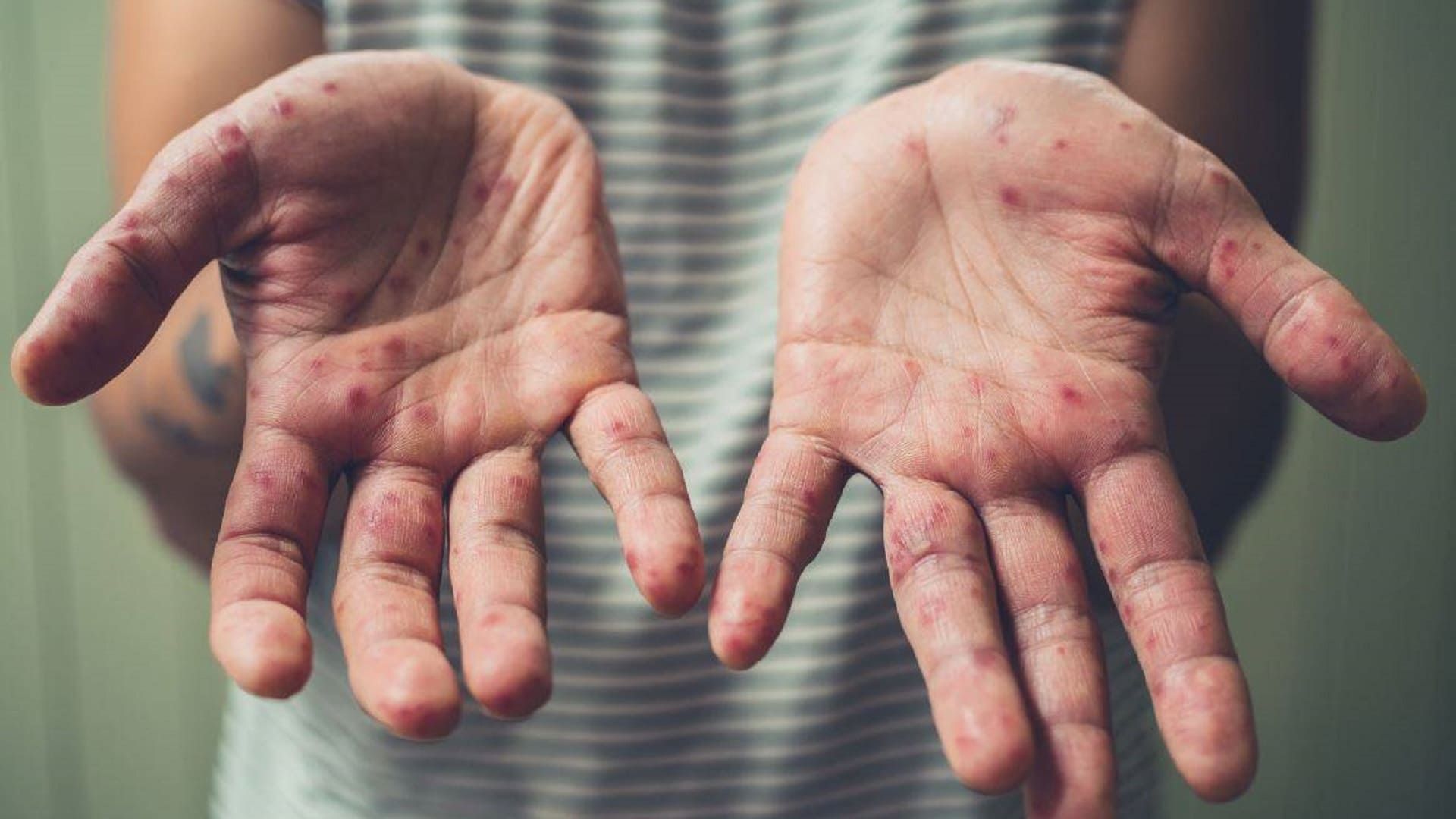 Emite Oaxaca alerta sanitaria por aumento de casos de sarampión y tosferina